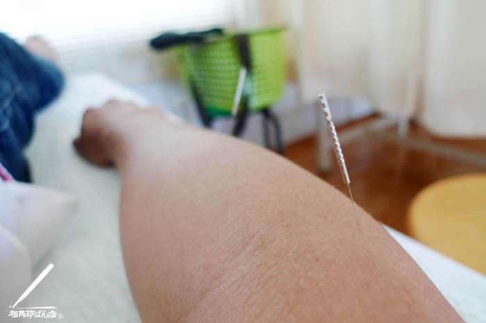 高鍋町の鍼灸院で鍼灸治療。痛みが取れて良かった。