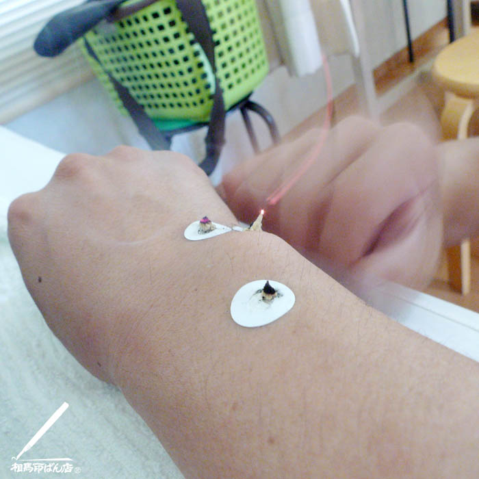 高鍋町のいまむら鍼灸院でお灸でツボに刺激を与えて痛みを取りました。